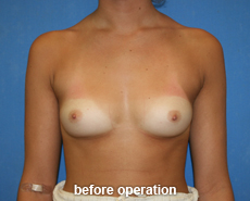 plastic-surgery-breast-augmentation
